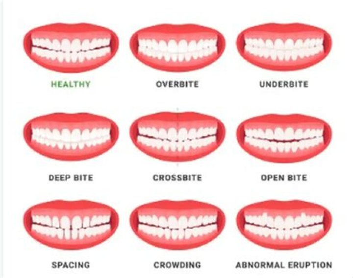 Are slightly crooked teeth attractive?
