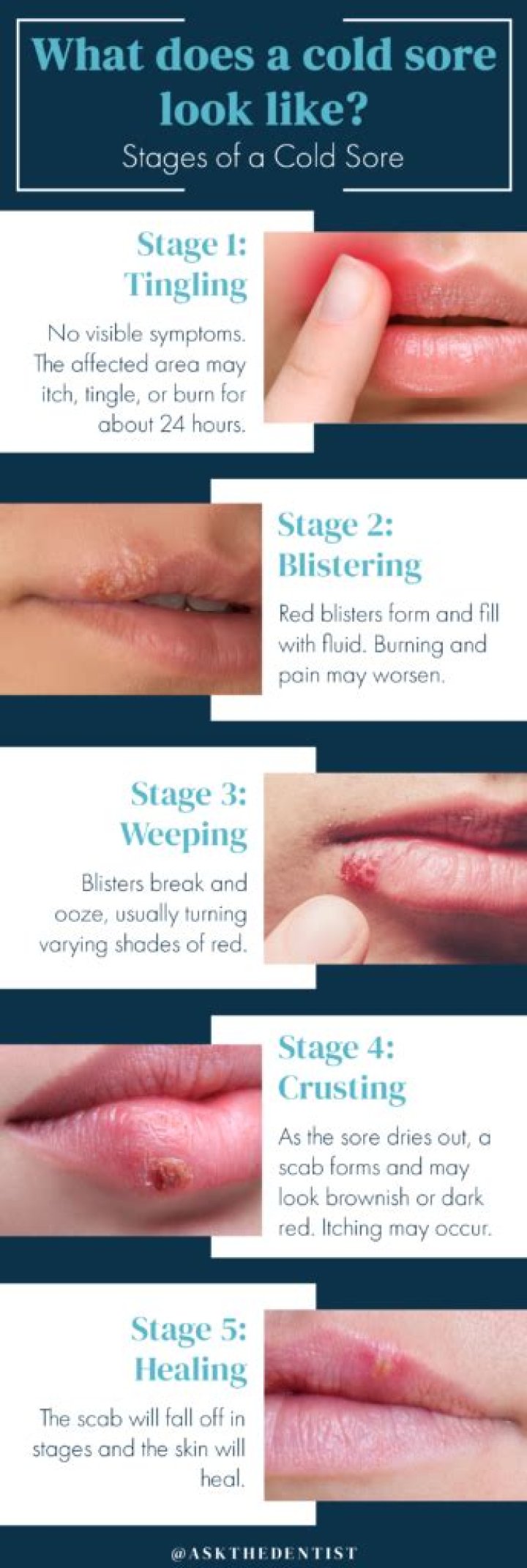 Can a cold sore scar be contagious?