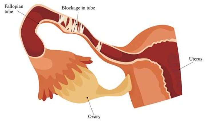 Can a cyst rupture your fallopian tube?