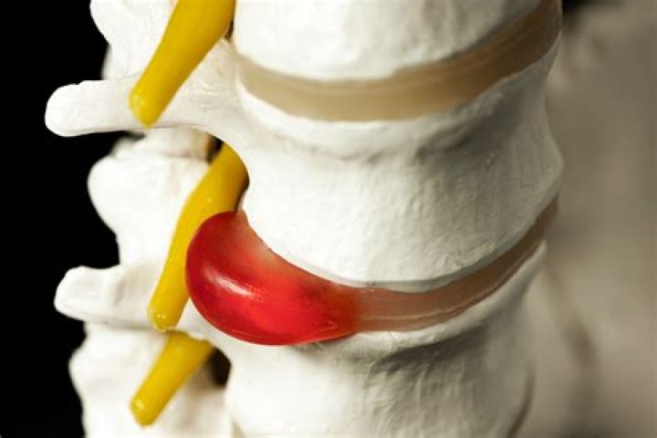 Can a sequestered disc heal?