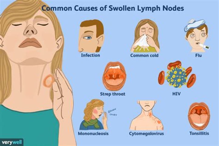 Can a sore tongue cause swollen lymph nodes?