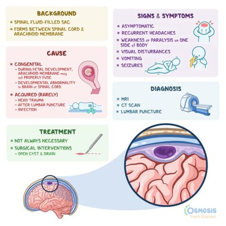 Can arachnoid cysts cause pain?