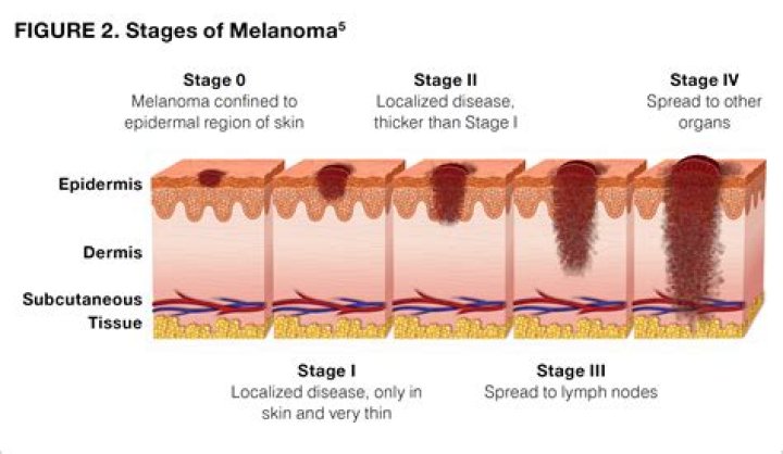 Can biopsy cause melanoma to spread?