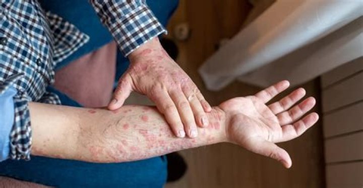 Can digestive problems cause skin rash?