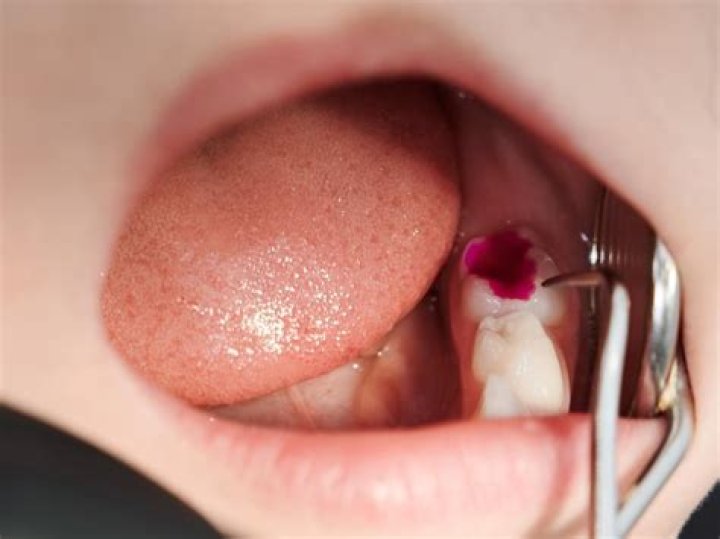 Can I get 3 cavities filled at once?