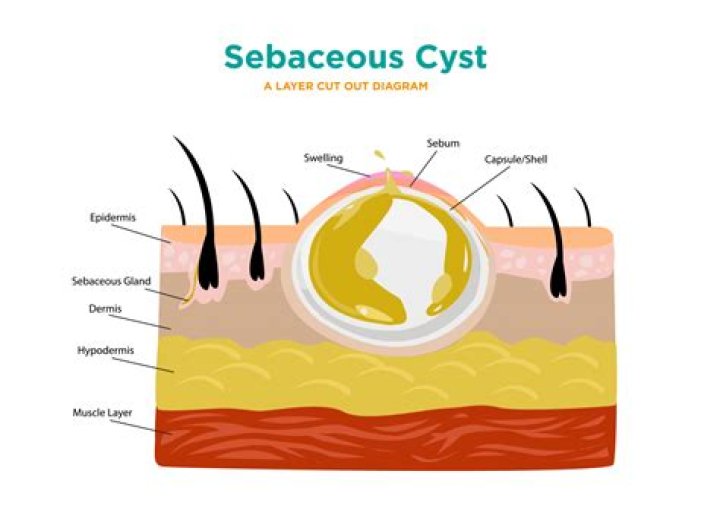 Can I remove sebaceous cyst myself?