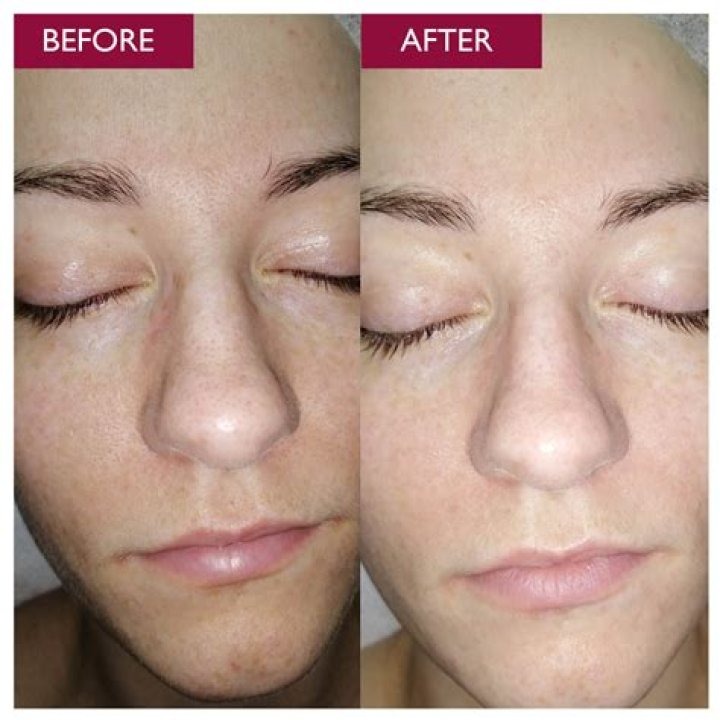 Can I wear makeup after glycolic acid?