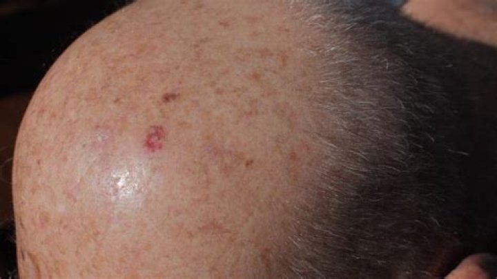 Can lumps on head be cancer?