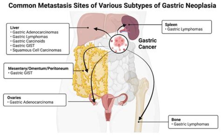 Can lung metastases be cured?