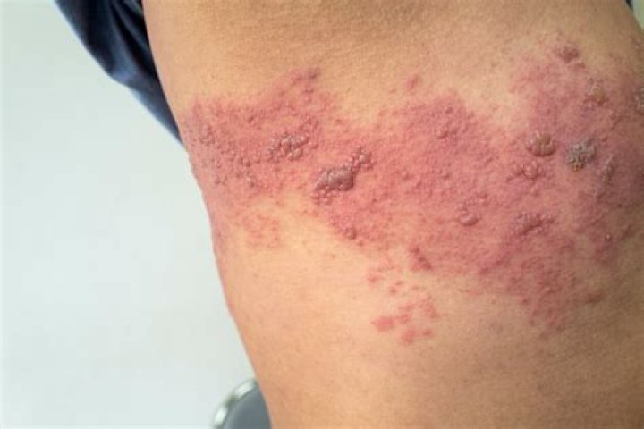 Can pregnancy trigger shingles?