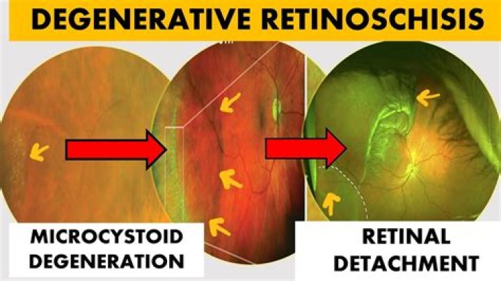 Can retinoschisis be treated?