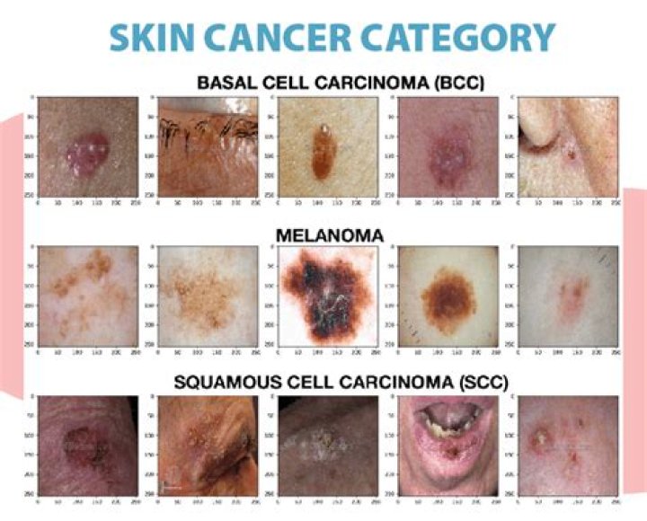 Can skin cancer cause GI issues?