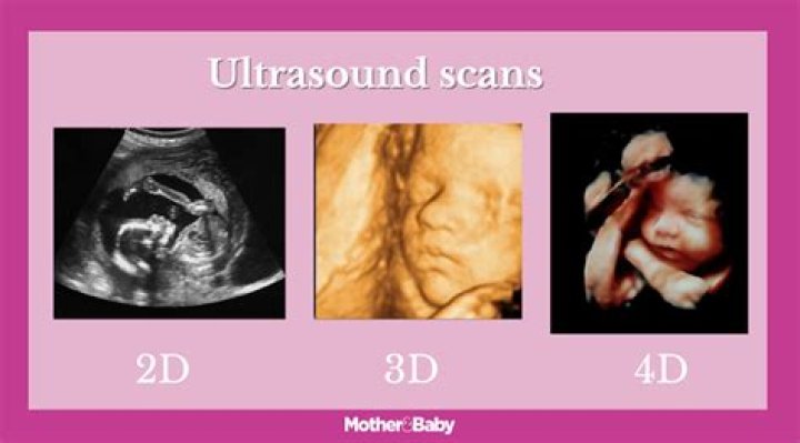 Can you get a 4D scan on the NHS?