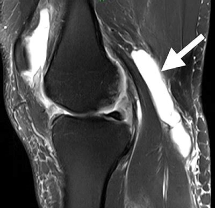 Can you see popliteal cyst on xray?