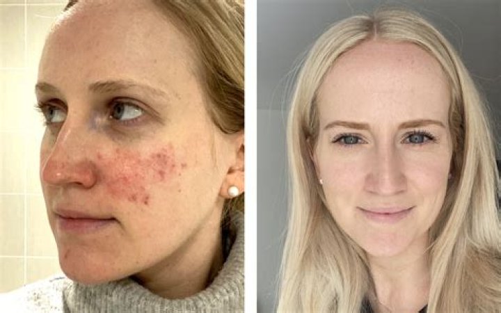 Can Zineryt be used for rosacea?