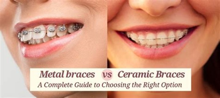 Do ceramic braces discolor?