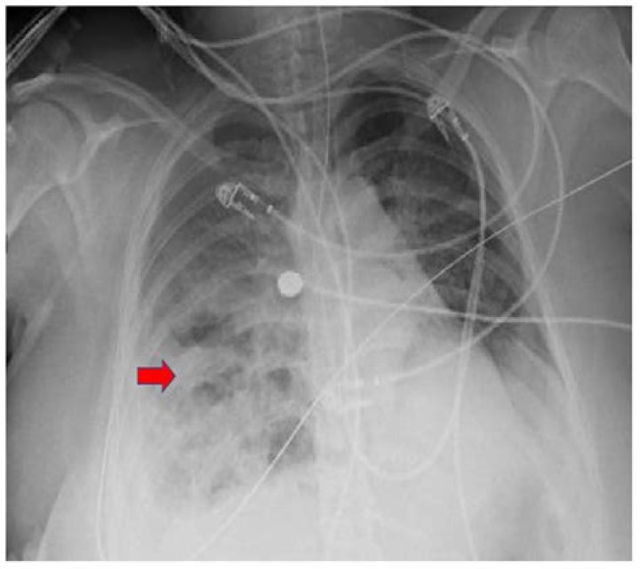 Do you need a chest X ray after intubation?