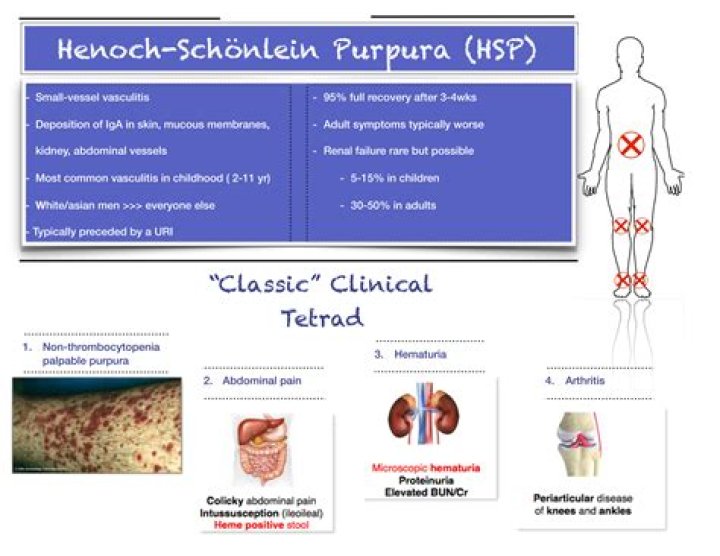 Does Henoch Schonlein Purpura occur in adults?