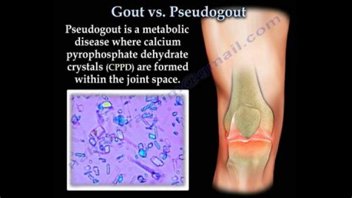 Does Pseudogout show up on MRI?