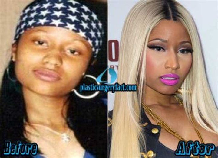 Has Nicki Minaj done a surgery?