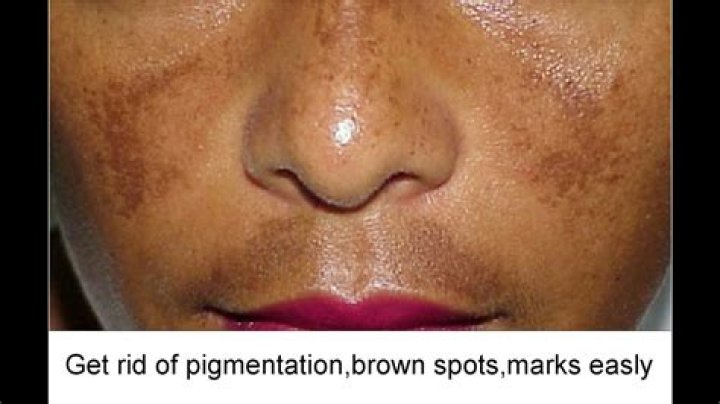How can I remove pigmentation marks on my face?