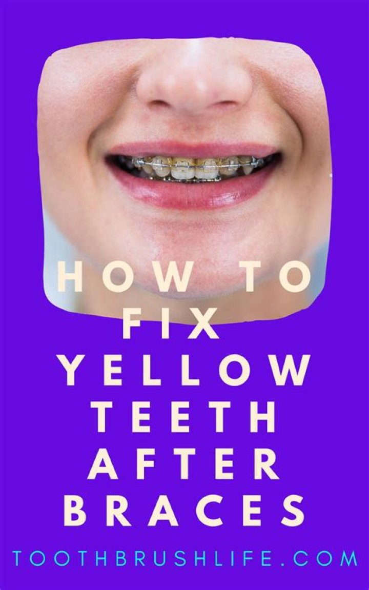 How do I get rid of yellow stains on my teeth from braces?