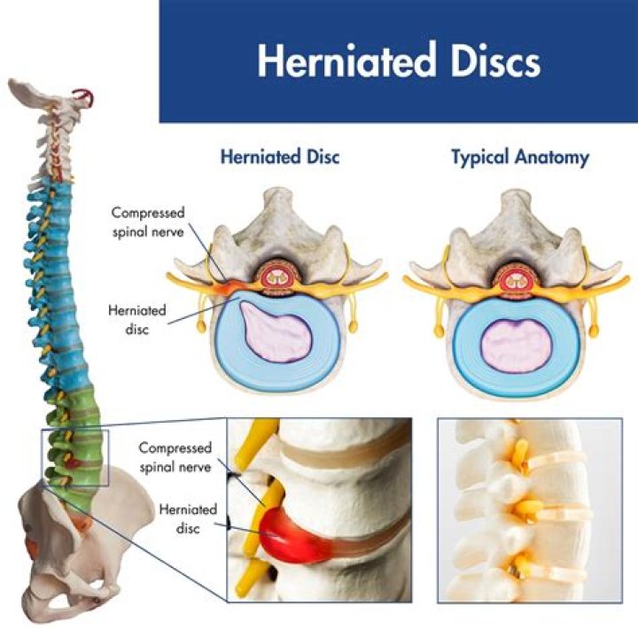 How do I know if my dog has a herniated disc?