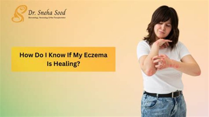 How do I know if my rash is eczema?