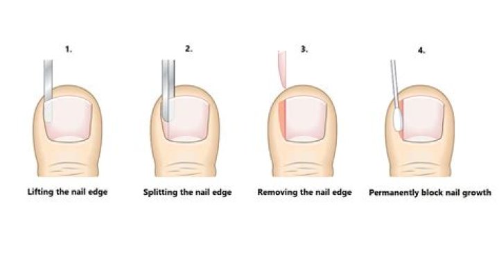 How do we reduce swelling in ingrown nails?