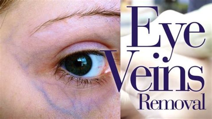 How do you get rid of blue veins under your eyes?