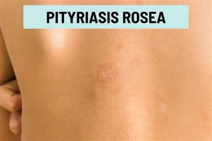How do you know if pityriasis rosea is healing?