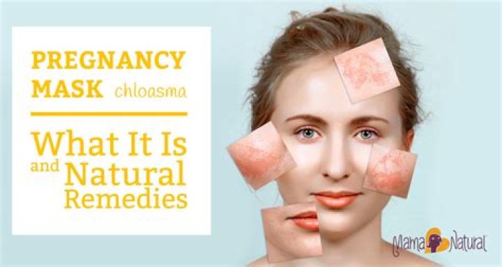 How do you make chloasma go away?