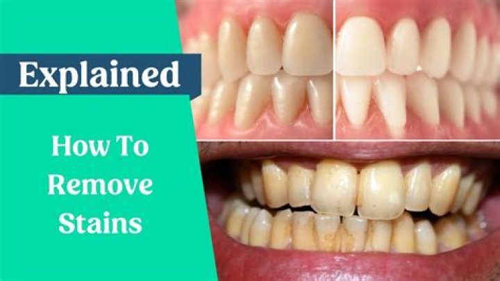 How do you remove brown stains from teeth?
