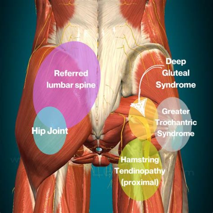 How do you treat an injured gluteus maximus?