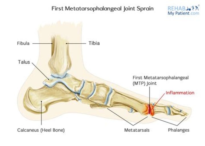 How do you treat an MTP joint?