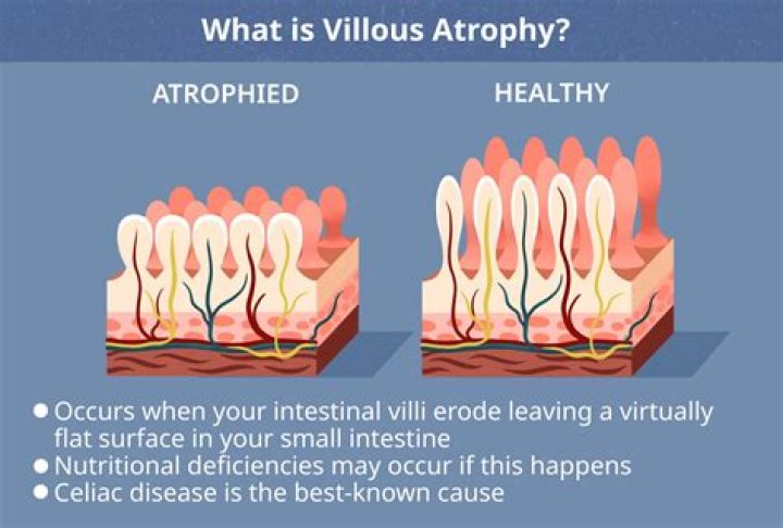 How do you treat villous atrophy?
