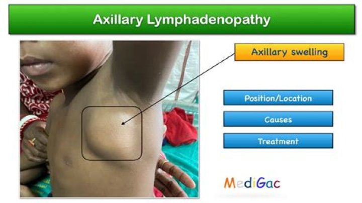 How is axillary lymphadenitis treated?