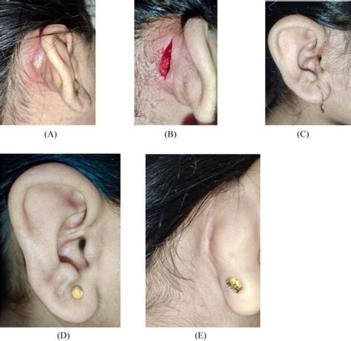 How is preauricular abscess treated?
