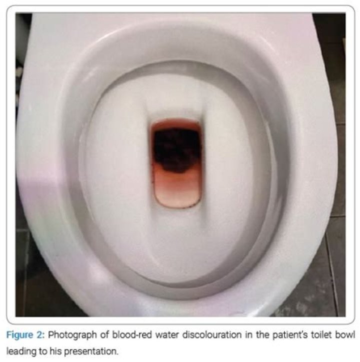 How long after eating beets is stool red?