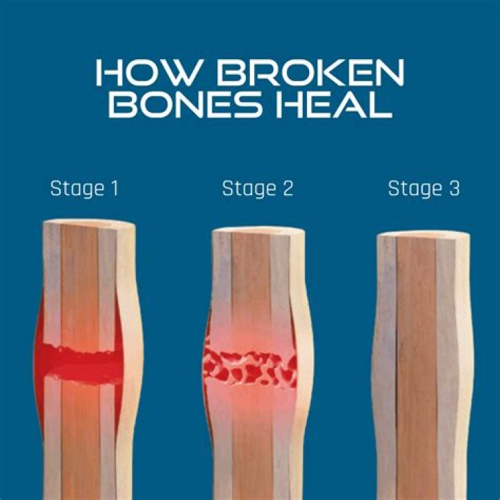 How long does a broken L1 take to heal?