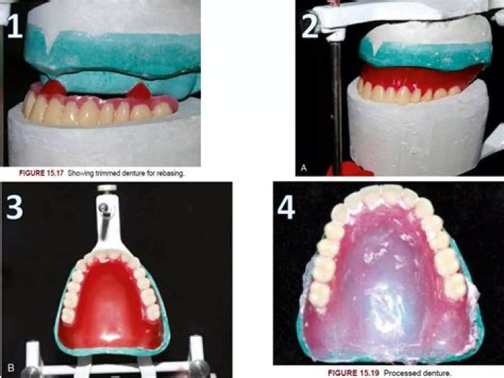 How long does a hard denture reline last?