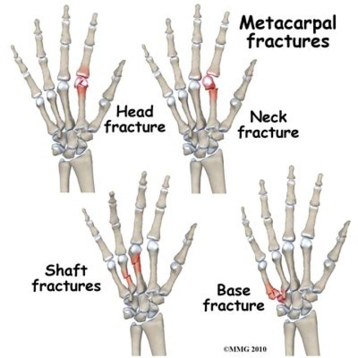 How long does a metacarpal fracture take to heal?