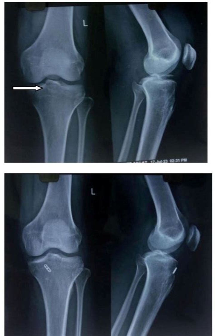 How long does an avulsion fracture of the elbow take to heal?