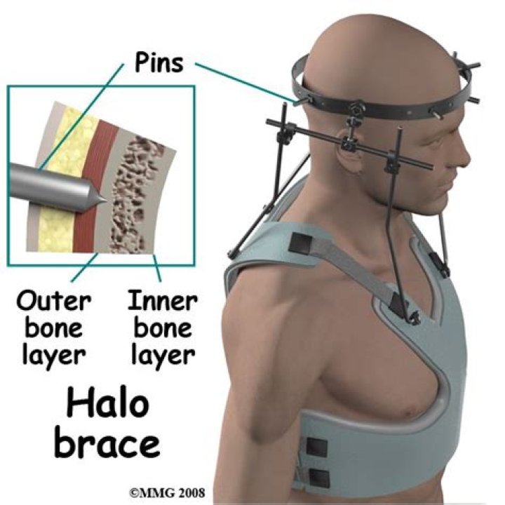 How long does Halo surgery take?