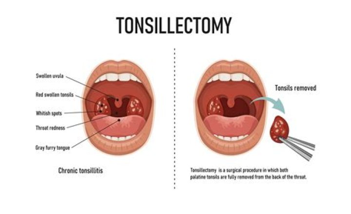How long does it take for uvula swelling to go down after tonsillectomy?
