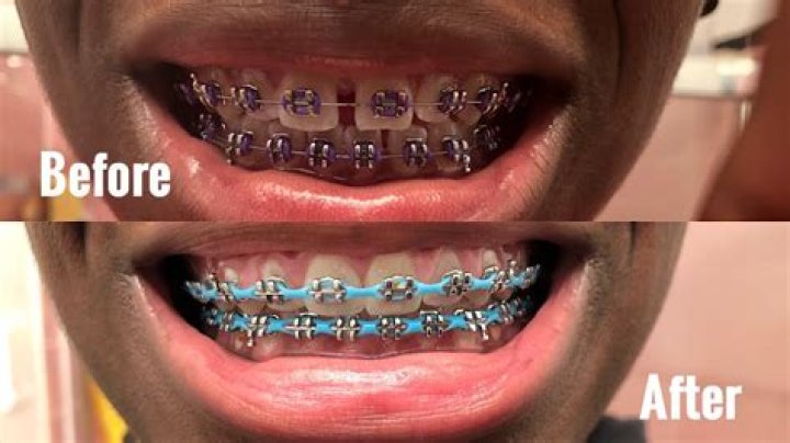 How long does it take for your gap to close with power chains?