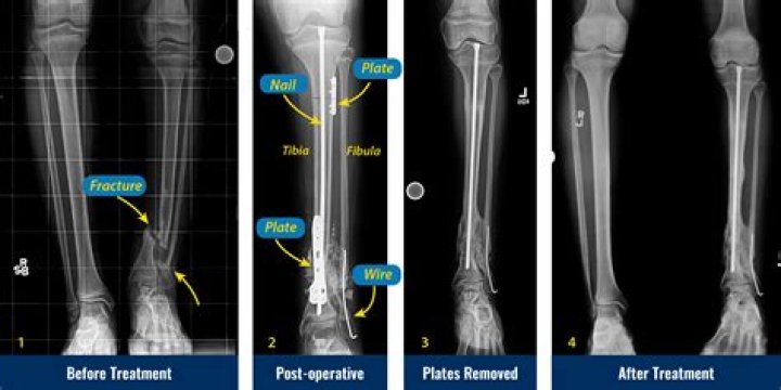 How long does it take to recover from a fractured tibia and fibula?