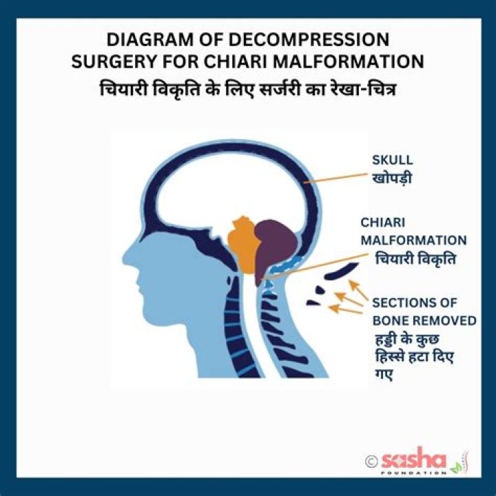How long does it take to recover from Chiari decompression surgery?