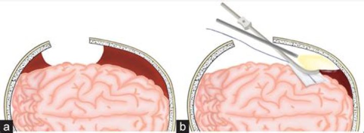 How long does subdural hematoma surgery last?