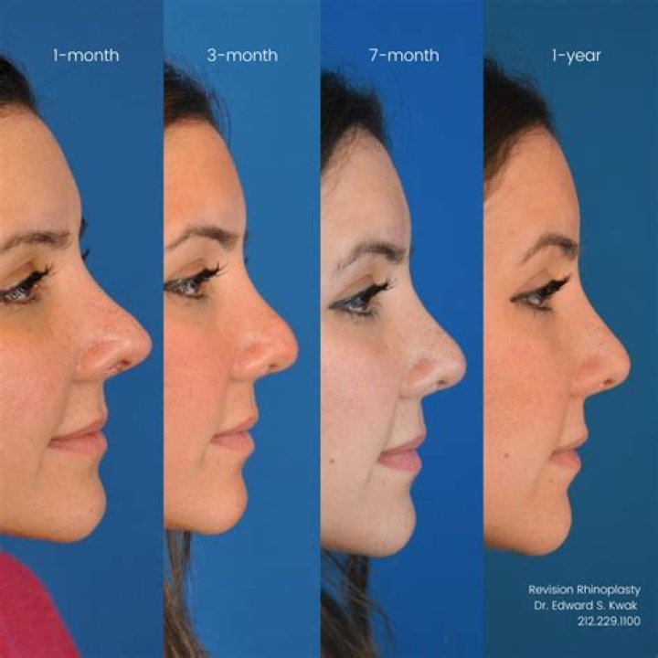 How long does swelling last after orthognathic surgery?